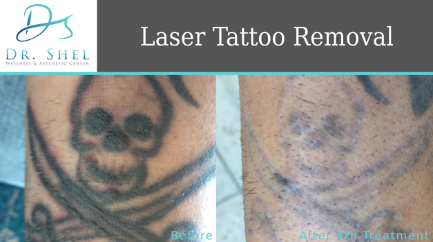 Removery Tattoo Removal  Fading 15293 Southwest Fwy Sugar Land TX Tattoos  Removed  MapQuest